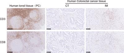 Clinicopathological Features Combined With Immune Infiltration Could Well Distinguish Outcomes in Stage II and Stage III Colorectal Cancer: A Retrospective Study